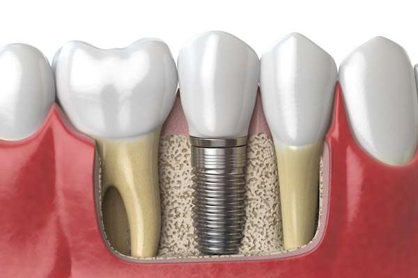 Dental Implants