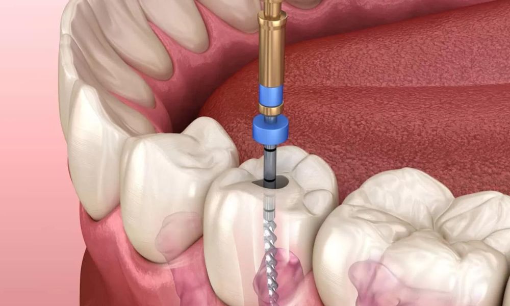 Factors That Affect the Price of a Root Canal in Boynton