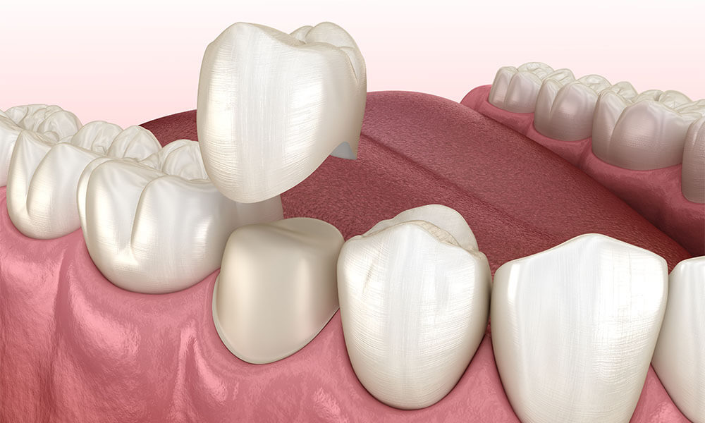 The Technology Behind Same-Day Crowns: How It Works