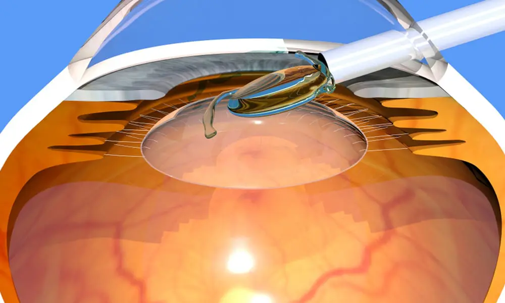 Phakic IOL: A Revolutionary Solution for Vision Correction