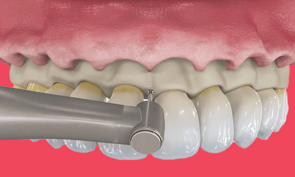 The Oral Health Advantage of Crown Lengthening: More Than Just a Cosmetic Fix