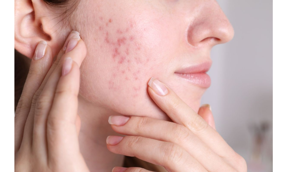 acne scar physician