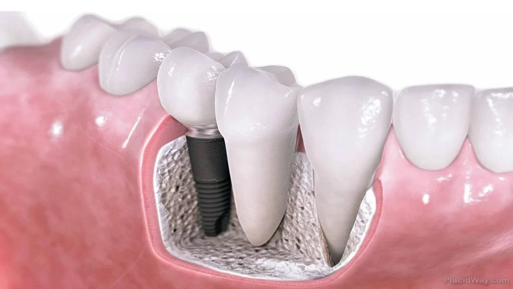 Transforming Smiles: How Implant Dentists and Periodontists Work Together for Optimal Oral Health