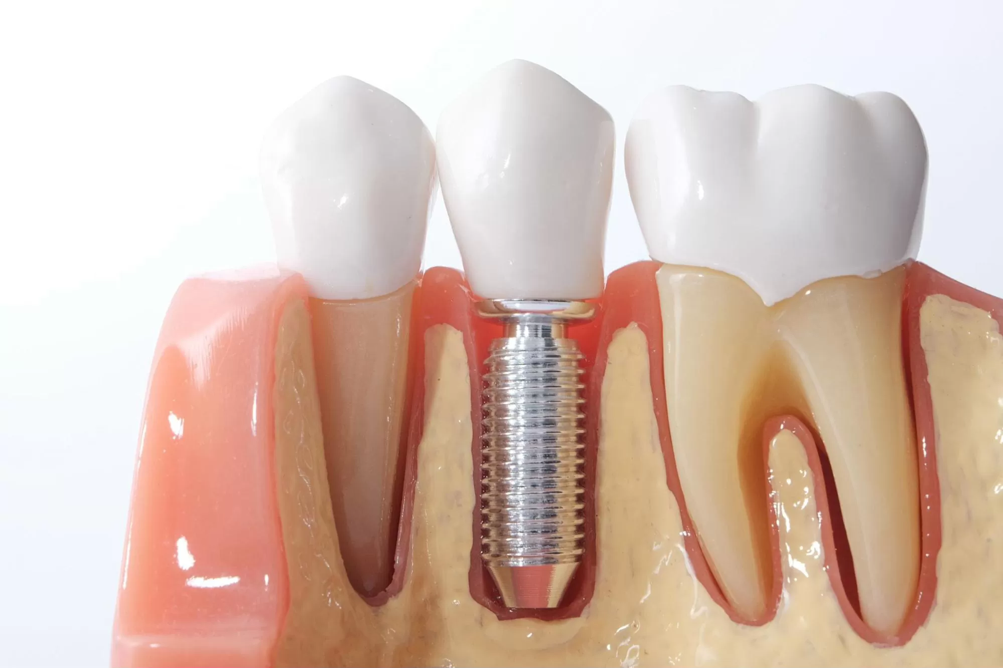 Understanding the Differences Between Dentures and Dental Implants